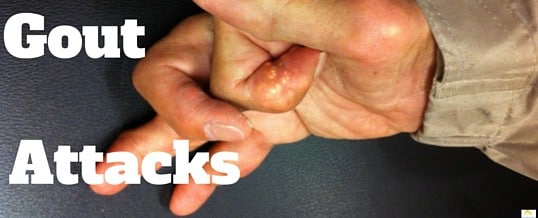 How to prevent gout attacks