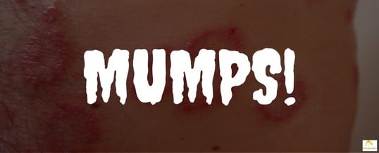 Mumps epidemic!