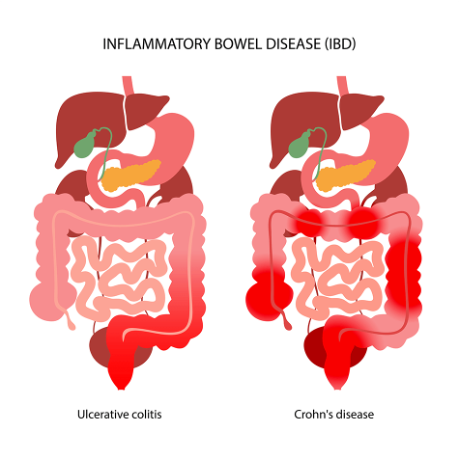 Hypnotherapy for Treating IBS and IBD