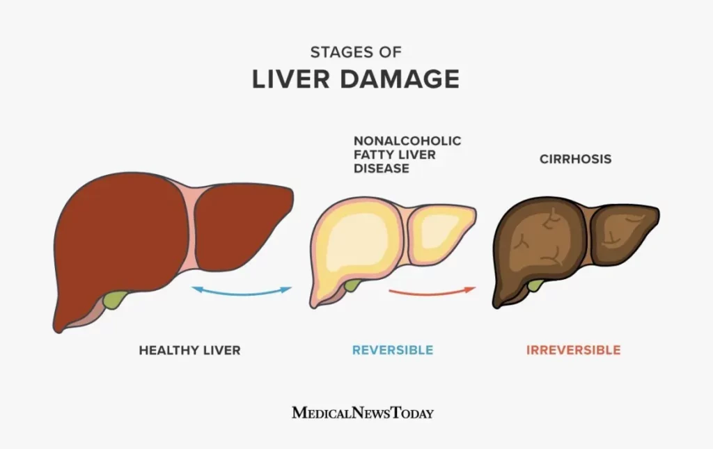 Progression of Fatty Liver Disease