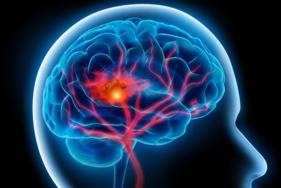 Cleerly Scan for Stroke Risk